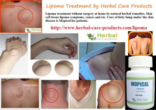 10-Natural-Home-Remedies-for-Lipoma1.jpg