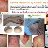 10-Natural-Home-Remedies-for-Lipoma1