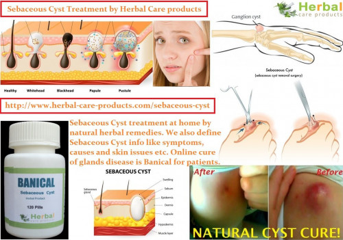 14-Herbal-Cures-for-Sebaceous-Cyst.jpg