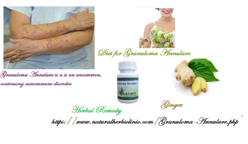 If you are observing any of these symptoms, make sure if you have granuloma annulare. If sure, you may try the Granuloma Annulare Herbal Treatment with out any side effects... https://www.naturalherbsclinic.com/blog/alternative-solution-for-granuloma-annulare-natural-herbal-remedies/