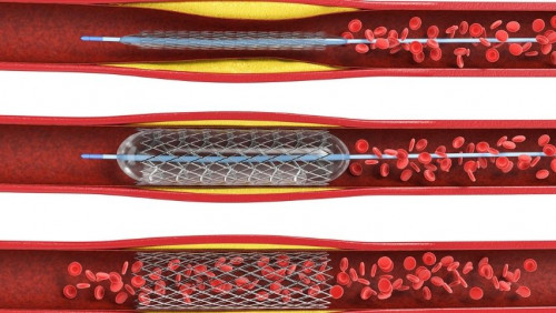 Angioplasty-Procedure.jpg