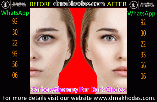 Reduce all your dark circles surrounding your eyes! We at Dr. Nakhoda's Skin Institute offer you the best Carboxytherapy for dark circles. With extensive years of experience, we bring you the best treatment to eliminate your dark circles. Book an appointment now!