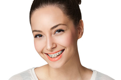 Dentacare-Metal-Braces---P14999P80000-410-a.jpg