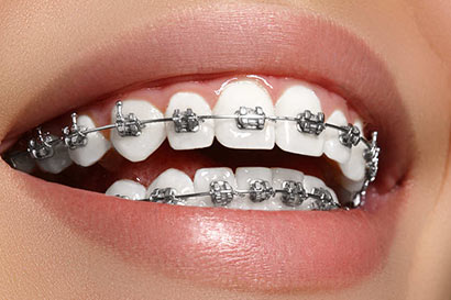 Dentrica-Dental-Center-Upper-and-Lower-Metal-Braces---P4199P60000-410-c.jpg