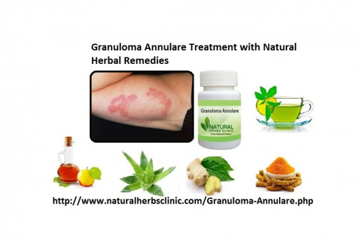 There are many different herbal remedies for the Herbal Treatment for Granuloma Annulare which work positively without any side effects. Natural Herbs Clinic deal in the treatment different kinds of disease especially in Granuloma Annulare Herbal Treatment with useful herbal remedy.... https://herbsclinic.cheezburger.com/