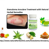 Different-Herbal-Remedies-for-the-Herbal-Treatment-for-Granuloma-Annulare