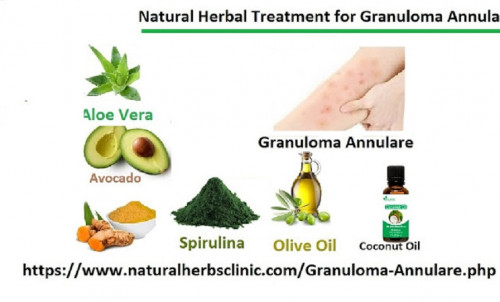 In clearer and shorter words our Herbal Treatment for Granuloma Annulare formulated to fight the symptoms of Granuloma Annulare is one of the best Natural Treatment for Granuloma Annulare so far because it has no side effects connected with it and the ingredients used in the formula are purely natural... http://naturalherbclinic.emyspot.com