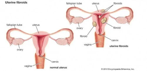 Enlarge-uterus.jpg