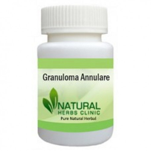 Natural remedies for granuloma annulare are also good option for manage the symptoms. Granuloma Annulare Herbal Treatment option for those suffering from widespread this condition. It is a recommended treatment of granuloma annulare that may be self-conscious or suffering from a severe condition... http://naturalherbclinic.emyspot.com/blog/granuloma-annulare-skin-disorder/herbal-treatment-for-granuloma-annulare.html