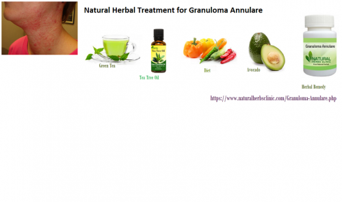 Calendula is the effective ingredient for Natural Herbal Treatment for Granuloma Annulare and also for many other skin problems such as ulcers, skin irritation, eczema, wounds and dry skin you can apply the calendula oil and leave it for a few hours... https://naturalcureproducts.wordpress.com/2015/10/22/granuloma-annulare-psychological-factors/