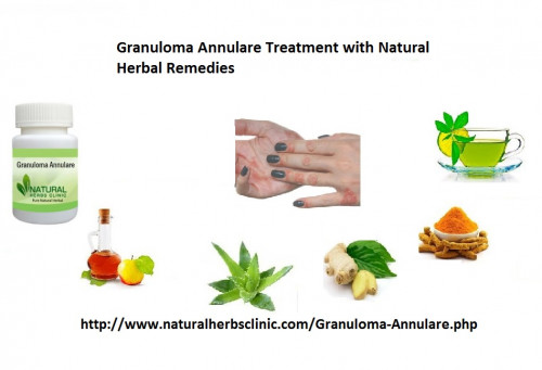 Try natural herbal remedies for Herbal Treatment for Granuloma Annulare because these remedies totally prepared with herbal ingredients which are very effective and play a vital role to get rid of granuloma annulare without any side effects... https://www.trepup.com/naturalherbsclinic/timeline