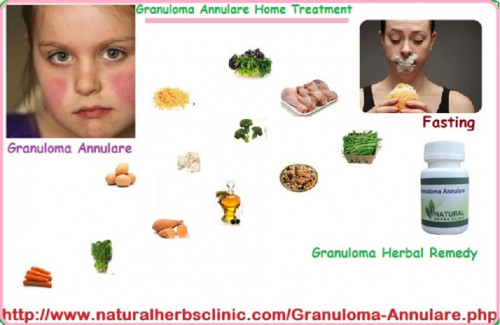 Baking soda is one of the useful ingredients for Herbal Treatment for Granuloma Annulare it is versatile and available ingredient in the kitchen. Baking soda can be used to treat various skin problems and conditions... https://naturalcureproducts.wordpress.com/2015/11/02/granuloma-annulare-a-perpetual-degenerative-skin-issue/