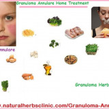 Granuloma-Annulare-a-perpetual-degenerative-skin-issue