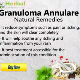 Granuloma-Annularea219c23c73816011