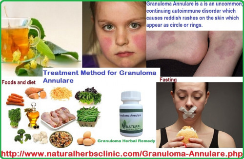 Common Natural Herbal Treatment for Granuloma Annulare comprise apple cider vinegar use topically and taken orally, DMSO, tannic acid, milk of lysine and magnesia... https://granulomaannularecauses.blogspot.com/2017/05/granuloma-annulare-causes-diet.html