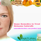 Home-Remedies-for-Melasma