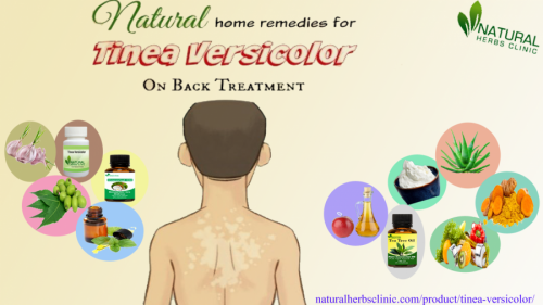 Garlic is also one of the effective Natural Remedies for Tinea Versicolor. Its antifungal properties help stop the growth of fungi and provide relief from itching... https://naturalherbcure.livejournal.com/4086.html