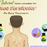 Home-Remedies-for-Tinea-Versicolor