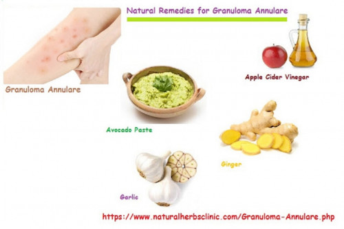 An individual can use different home remedies and Natural Herbal Treatment for Granuloma Annulare to obtain relief from this problem... https://www.naturalherbsclinic.com/blog/how-to-stop-granuloma-annulare-with-natural-herbal-treatment/