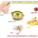 How-To-Stop-Granuloma-Annulare-With-Natural-Herbal-Trearment