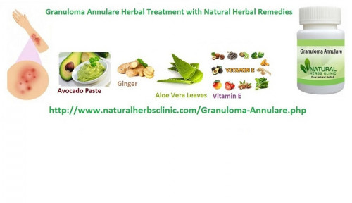 Herbal Treatment for Granuloma Annulare crushes some Aloe Vera leaves to make a paste. Apply and massage this paste on the affected areas. Aloe Vera contains a natural gel that causes a soothing. It will possibly lessen the itching and pain that will be caused by granuloma annulare... http://naturalherbclinic.emyspot.com/blog/granuloma-annulare-skin-disorder/herbal-treatment-for-granuloma-annulare.html