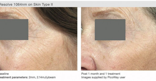 Laser-Tattoo-removal-for-a-Smoother-and-Youthful-Skin.jpg