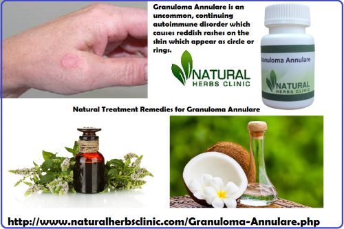 Natural Herbs Clinic is one of the best platform for the treatment of different kind of disease. Especially for Natural Herbal Treatment for Granuloma Annulare this company have effective herbal remedy which is made with pure herbal ingredients and these ingredients work deeply and provide successful fast result without any side effects... https://mix.com/curewithherbs/herbal-treatment-for-granuloma-annulare