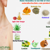 Natural-Remedies-for-Acne