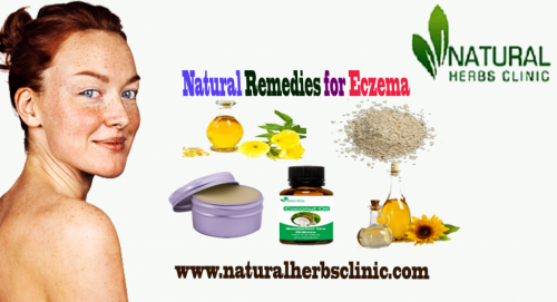 Witch hazel is an astringent derived from the bark and leaves of the hazel bush. It has been used for centuries as one of the topical Natural Remedies for Eczema and inflammation of the skin... https://www.naturalherbsclinic.com/blog/natural-remedies-for-eczema/