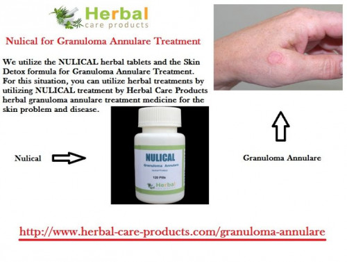 Herbal Treatment for Granuloma Annulare granuloma Annulare which is characterized by the presence of small, firm red or yellow colored bumps which appear arranged in a ring on the skin. It is that condition in which it consists of reddish, raised lesions which tend to form the patterns of ring. It can under the skin of the arms, legs or in some cases it can spread in all part of the body.

https://www.herbal-care-products.com/blog/10-natural-remedies-for-granuloma-annulare/