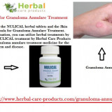 Natural-Treatment-for-Granuloma-Annulare