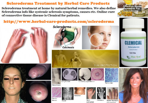 Herbal Treatment for Scleroderma will be to relieve the symptoms such as, hardness of skin, joint pain, and dry cough, shortness of breath, Diarrhea and difficulty swallowing to stop the condition.

https://www.herbal-care-products.com/blog/10-natural-remedies-for-scleroderma/