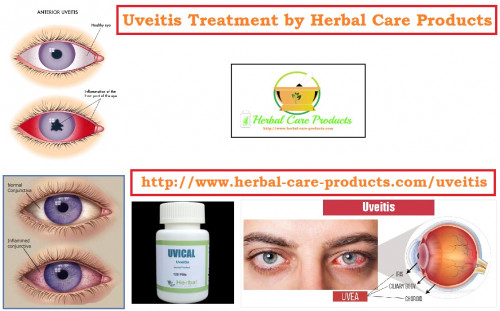 Herbal Treatment for Uveitis eye inflammation can help provide instant relief for your symptoms. Natural Remedies for Uveitis reduce swelling, redness and cure pain. It will also stop the pupil from sticking to the lens.

https://www.herbal-care-products.com/blog/10-natural-remedies-for-uveitis/