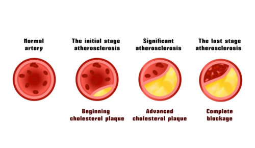 Plaque-Buildup-Stages.jpg