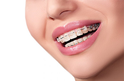 Pristine-Smile-by-Dental-Collaborations-Upper-and-Lower-Braces-multideal---P4999P75000-410-b.jpg