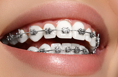 Pristine-Smile-by-Dental-Collaborations-Upper-and-Lower-Braces-multideal---P4999P75000-410-d.jpg