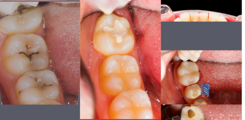 Root-canal-Treatment-cost-in-Bhopal746fcc7908221679.png