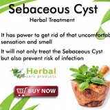 Sebaceous-Cyst