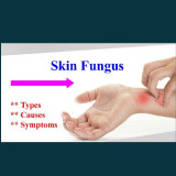 Skin-Fungus