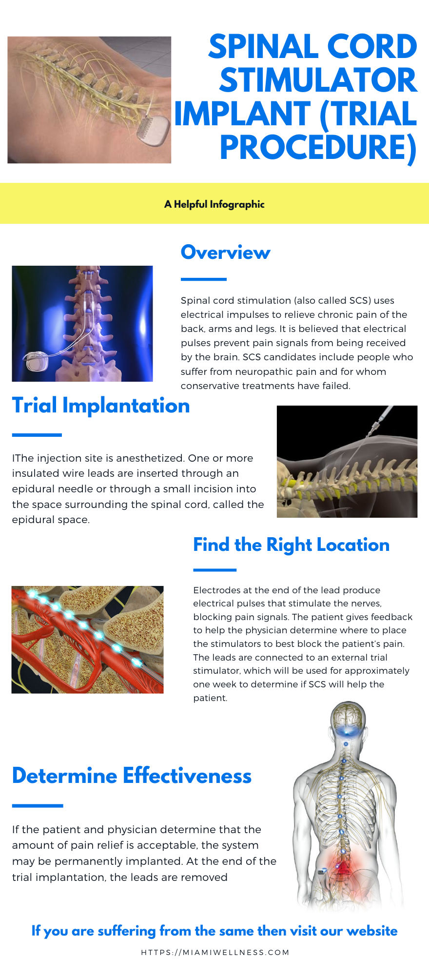 Spinal Cord Stimulator Implant Trial Procedure Gifyu