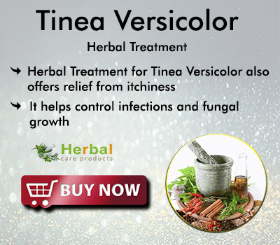 Tinea-Versicolor.jpg