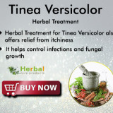 Tinea-Versicolor33a079fdf56e8847