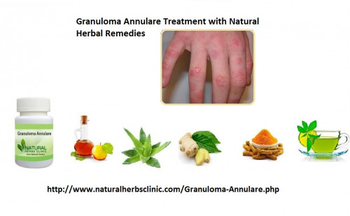 Natural herbal remedies for granuloma annulare are also good option for manage the symptoms. Granuloma Annulare Herbal Treatment option for those suffering from widespread this condition. It is a recommended treatment of granuloma annulare that may be self-conscious or suffering from a severe condition... https://joindiaspora.com/people/8d56ba701038013453370242ac110004