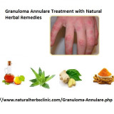 Try-Natural-Herbal-Remedies-for-Herbal-Treatment-for-Granuloma-Annulare