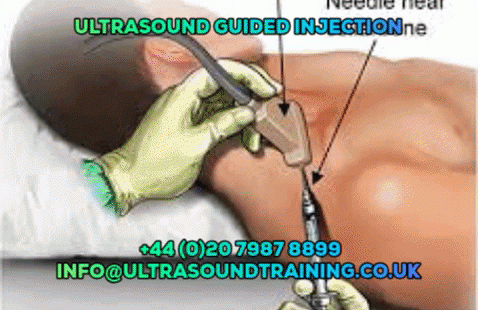 Guided Injection is a small interventional procedure that involves injecting a steroid into the appropriate area using ultrasound to guide the needle. Visit here to know more www.ultrasoundtraining.co.uk