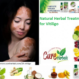 Vitiligo-Natural-Treatments--How-to-Cure-Vitiligo-by-Using-Natural-Vitiligo-Oil