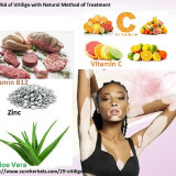 Vitiligo-and-Natural-Healing-Procedure