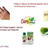 Vitiligo-and-its-Natural-Treatment-with-Effective-Vitiligo-Organics