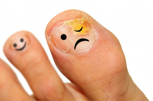 Do you know that Onychomycosis is caused by either toe fungus or fingernail fungus. Onychomycosis also known as tinea unguium. The most common symptom of a fungal nail infection is the nail becoming thickened and discolored. In this article we will are going to share how to cure Onychomycosis. Read: http://bit.ly/2XMJWs9