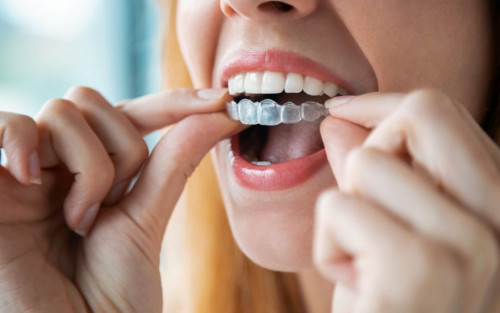 What-is-Unique-About-Invisalign.jpg